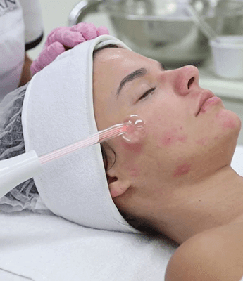 acne facial